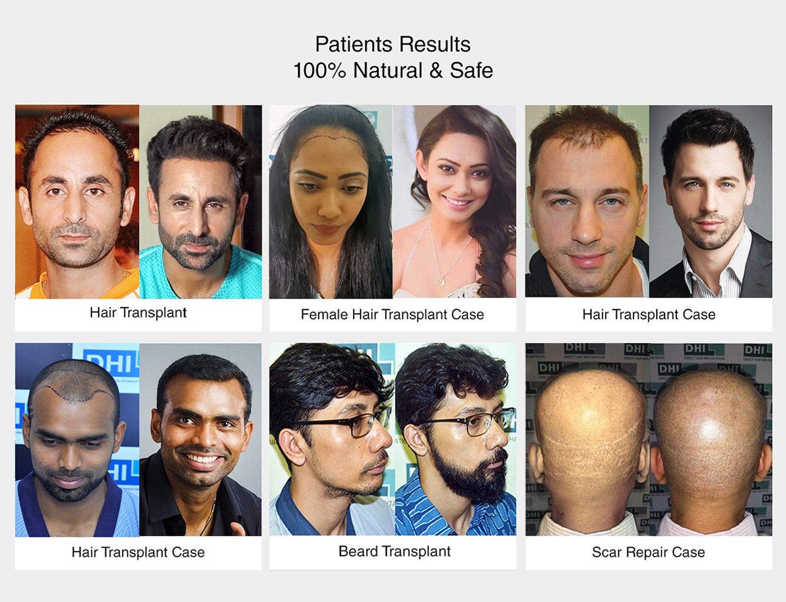 hair-transplant-free-consultaion-20%-discount